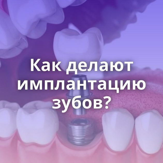 Как делают имплантацию зубов?
