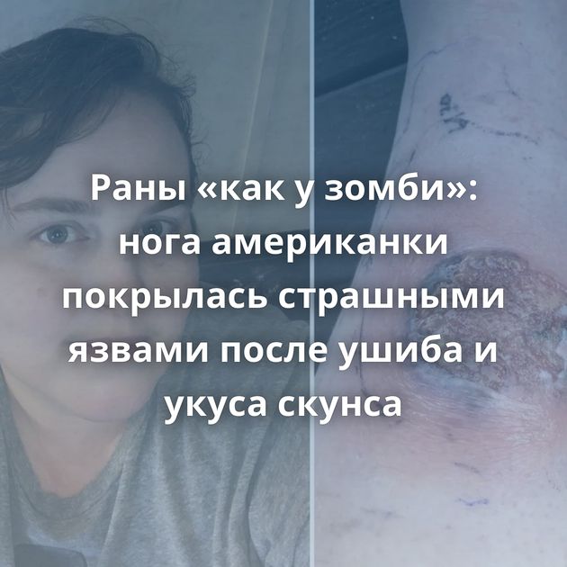 Раны «как у зомби»: нога американки покрылась страшными язвами после ушиба и укуса скунса