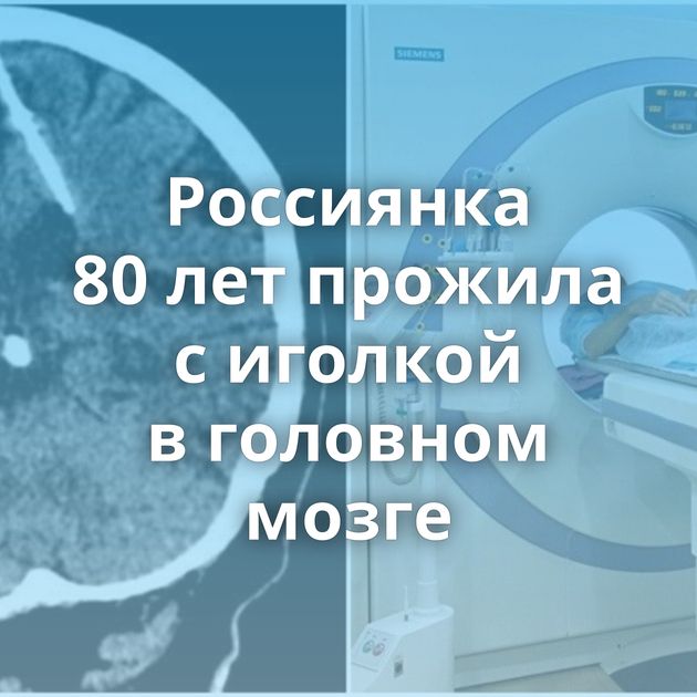 Россиянка 80 лет прожила с иголкой в головном мозге