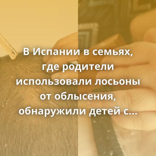 В Испании в семьях, где родители использовали лосьоны от облысения, обнаружили детей с 