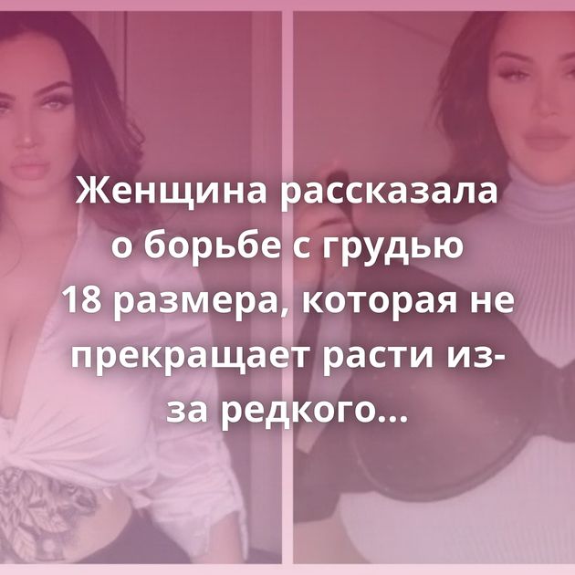 Женщина рассказала о борьбе с грудью 18 размера, которая не прекращает расти из-за редкого заболевания