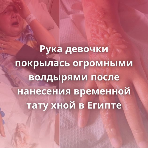 Рука девочки покрылась огромными волдырями после нанесения временной тату хной в Египте
