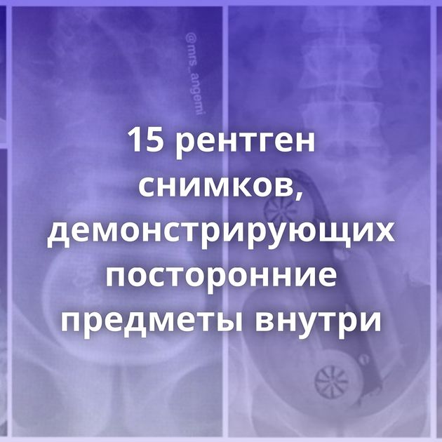 15 рентген снимков, демонстрирующих посторонние предметы внутри