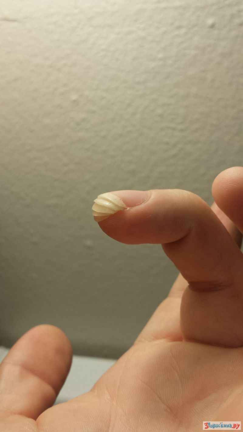 палец после удаления ногтя фото